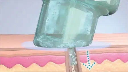 Gezeichnete schematische Darstellung einer Hydrafacial-Behandlung Schritt 2 Säurepeeling