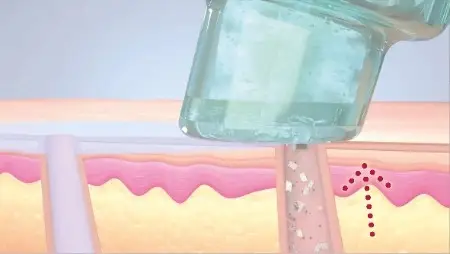 Gezeichnete schematische Darstellung einer Hydrafacial-Behandlung Schritt 3 Tiefenreinigung der Haut