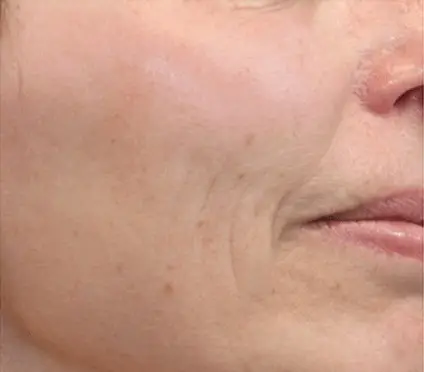 Ein Ausschnitt einer weiblichen Gesichtshälfte um die Mundparty als Vorherbild vor einer Dermatude Meta Therapy Behandlung mit Falten