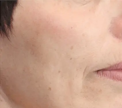 Ein Ausschnitt einer weiblichen Gesichtshälfte um die Mundparty als Nachherbild nach einer Dermatude Meta Therapy Behandlung ohne Falten