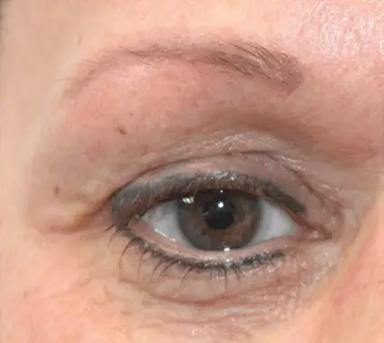 Ein weibliches Auge als Vorherbild vor einer Dermatude Meta Therapy Behandlung mit Falten