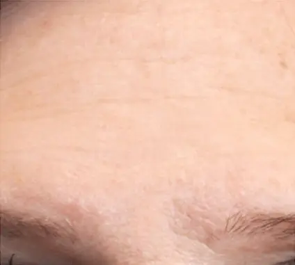 Die Strin als Nachherbild nach einer Dermatude Meta Therapy Behandlung ohne Falten