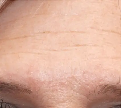 Die Strin als Vorherbild vor einer Dermatude Meta Therapy Behandlung mit Falten