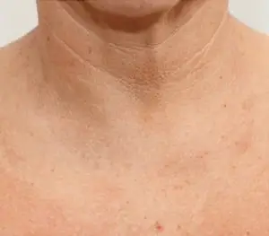 Ein Ausschnitt eines weiblichen Dekolettes als Vorherbild vor einer Dermatude Meta Therapy Behandlung mit Falten und dunklen Punkten