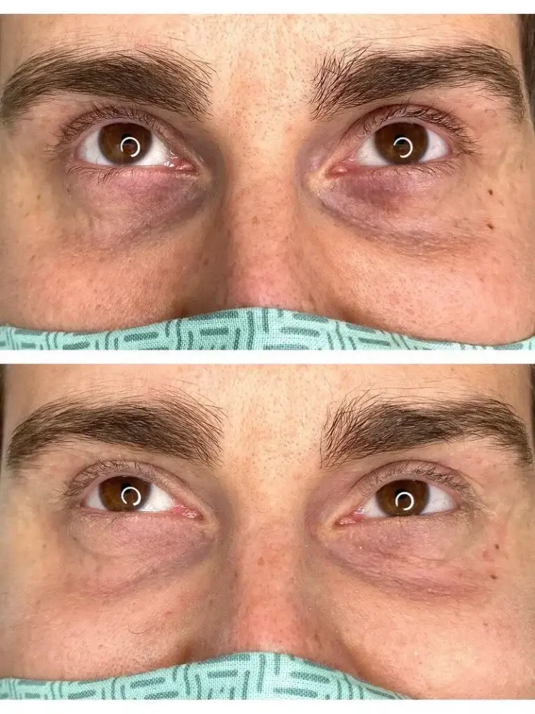 Zwei übereinander liegende vorher/nachher Aufnahmen einer CCeye Behandlung gegen dunkle Augenringe und Augenschatten. Es wird nur die Augenparty des männlichen Kunden gezeigt. Man sieht die deutliche positive Veränderung auf dem unteren Nachher-Bild.