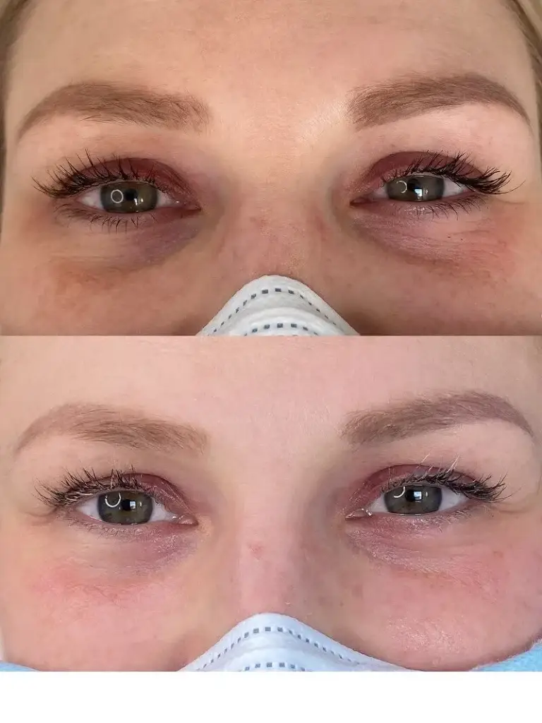 Zwei übereinander liegende vorher/nachher Aufnahmen einer CCeye Behandlung gegen dunkle Augenringe und Augenschatten. Es wird nur die Augenparty der Kundin gezeigt. Man sieht die deutliche positive Veränderung auf dem unteren Nachher-Bild.