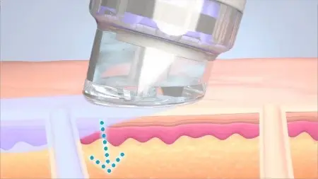 Gezeichnete schematische Darstellung einer Hydrafacial-Behandlung Schritt 4 Hydration der Haut