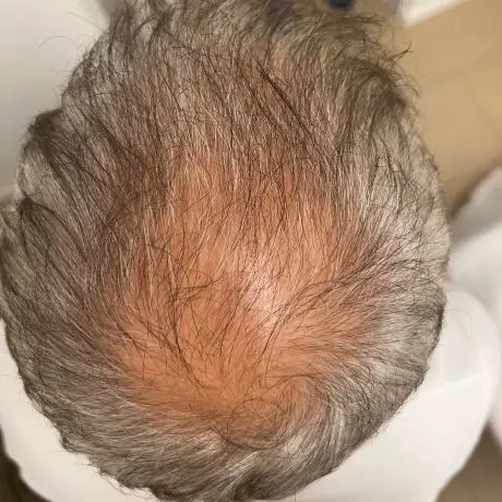 Meta Therapy Haare - mänlicher Kundenkopf mit grauen lichten Haaren vor der Behandlung