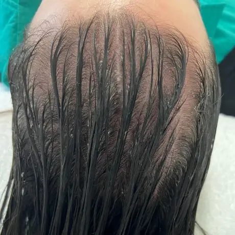 Meta Therapy Haare - Kundenkopf mit schwarzen Haaren nach der Behandlung