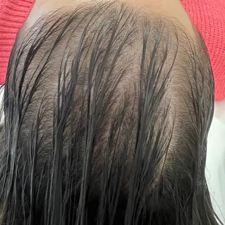 Meta Therapy Haare - Kundenkopf mit schwarzen Haaren vor der Behandlung