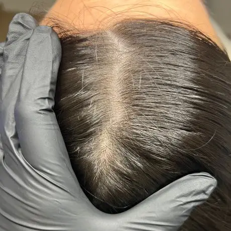 Meta Therapy Haare - weiblicher Kundenkopf mit schwarzen Haaren vor der Behandlung am Scheitel