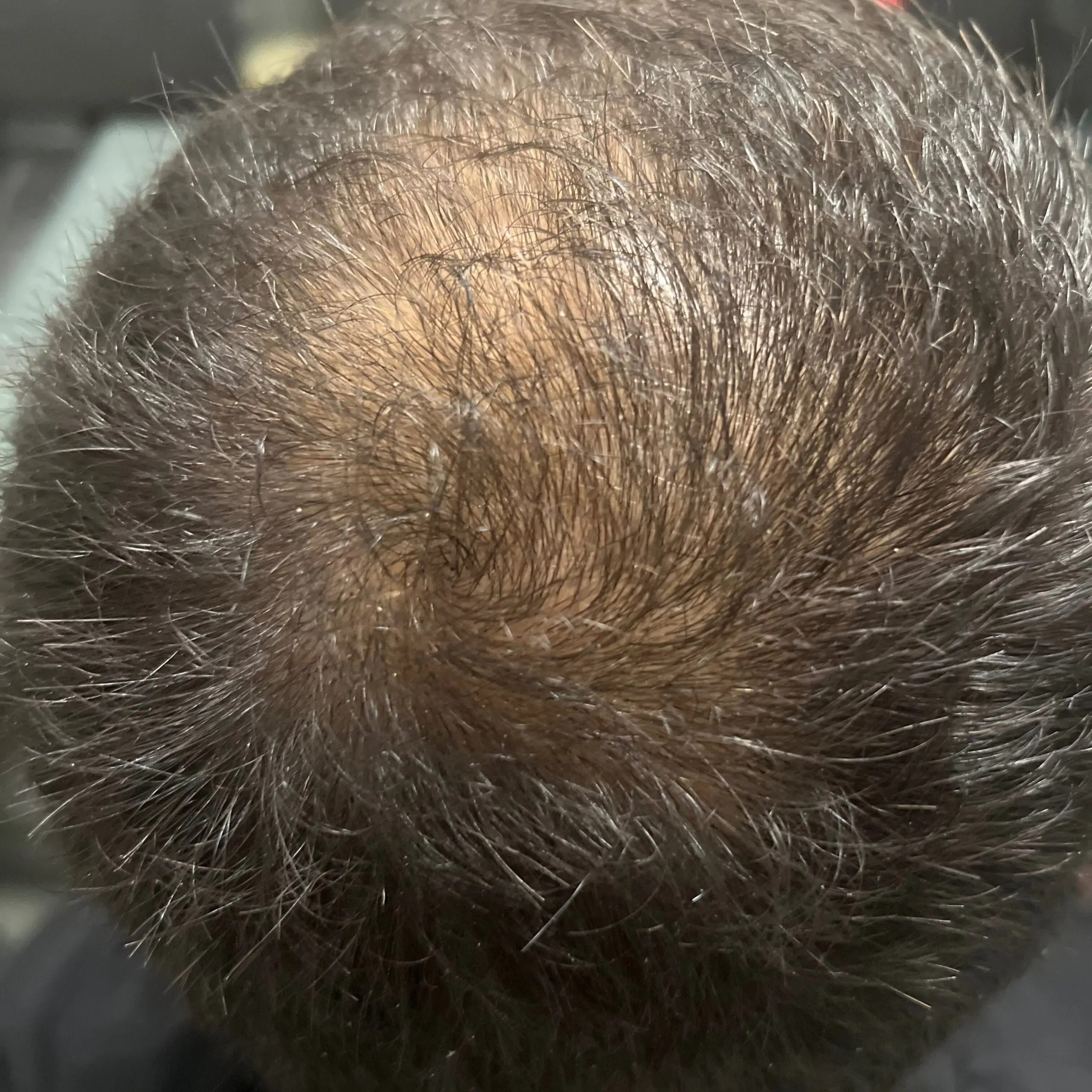 Meta Therapy Haare - mänlicher Kundenkopf mit schwarzen Haaren nach der Behandlung