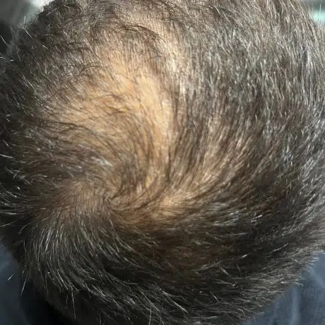 Meta Therapy Haare - mänlicher Kundenkopf mit schwarzen lichten Haaren vor der Behandlung
