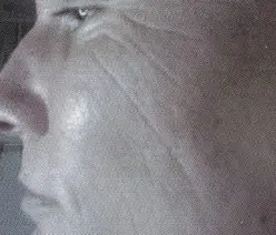 Vorher - Behandlungsbild einer Gesichtshälfte vor der Laserbehandlung mit dem Kaltlaser von Vita Control.